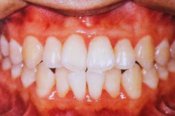 歯周病のAFTER