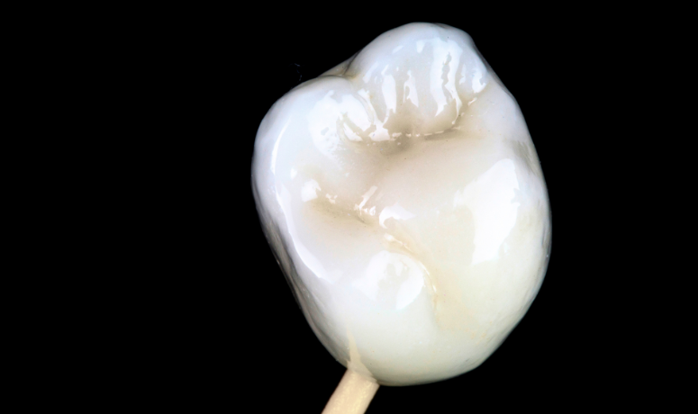 セラミッククラウン｜まきの歯科