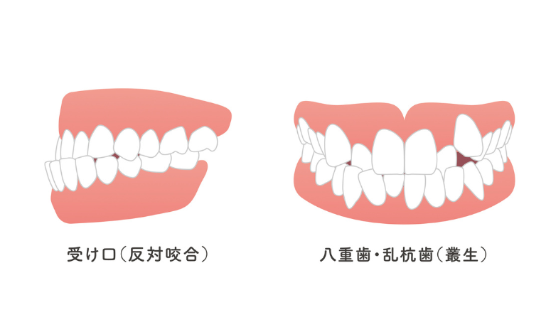 治療開始の一般的な目安｜まきの歯科