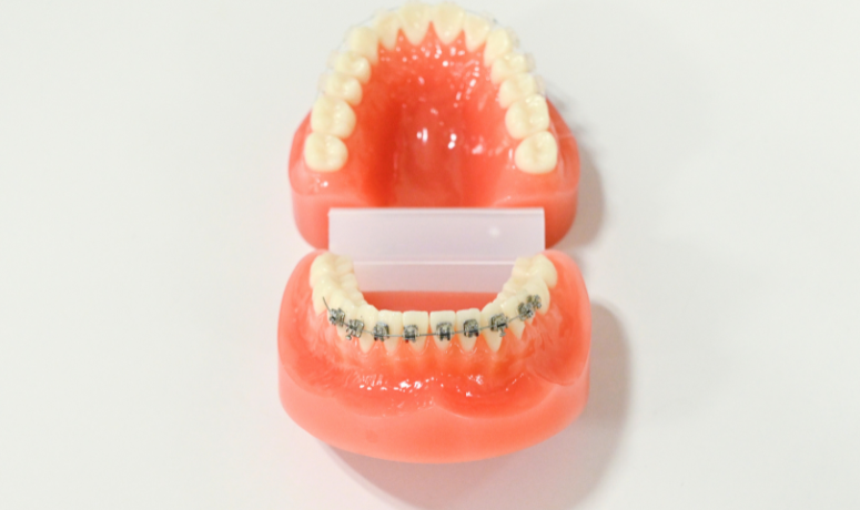 ワイヤー矯正｜まきの歯科