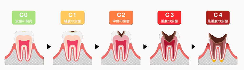 虫歯の進行｜まきの歯科
