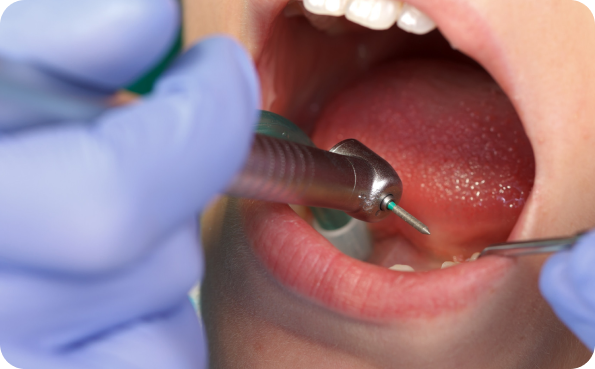 咬合調整｜まきの歯科