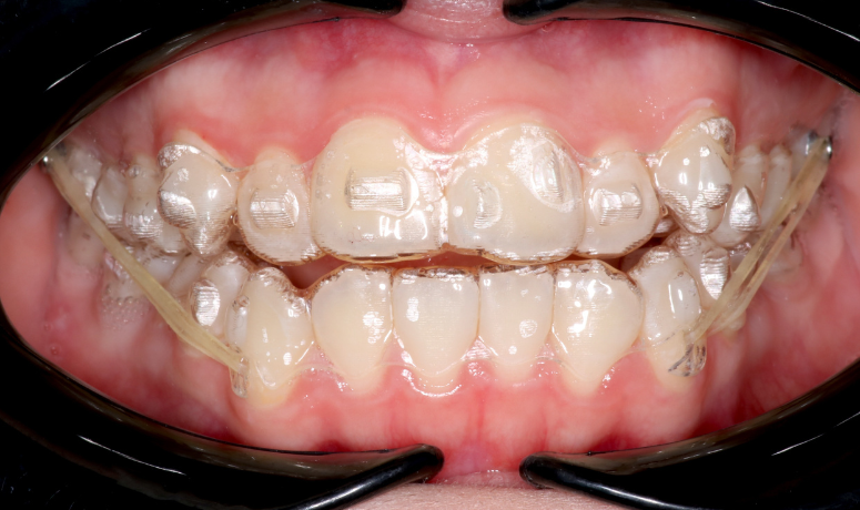 痛みが少ない｜まきの歯科