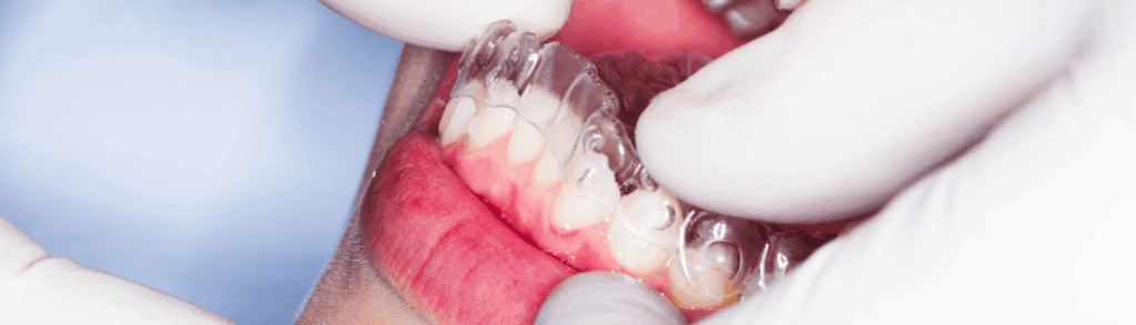 インビザライン治療の流れ｜まきの歯科