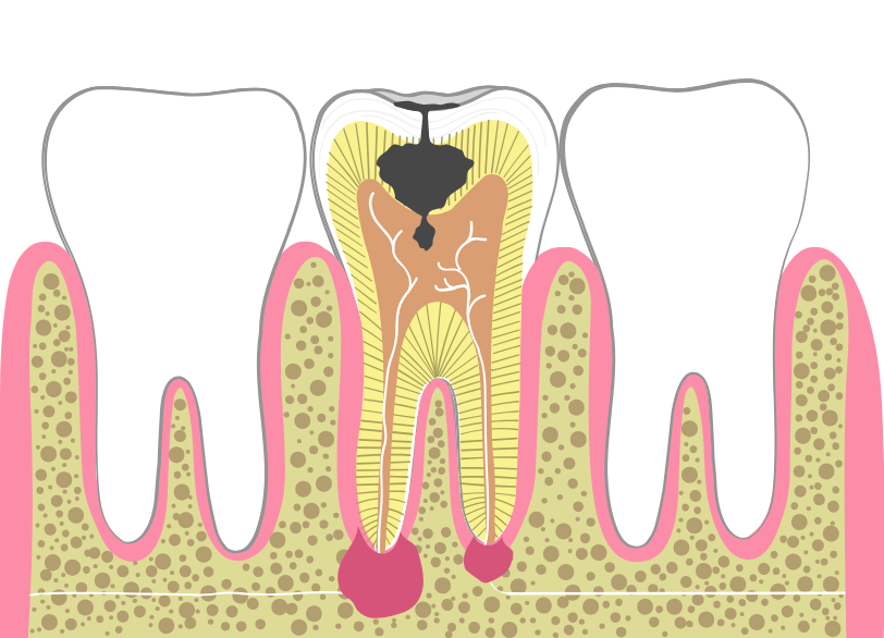 根管治療|まきの歯科