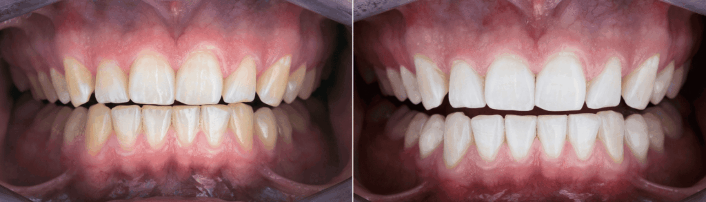 ホワイトニング|まきの歯科