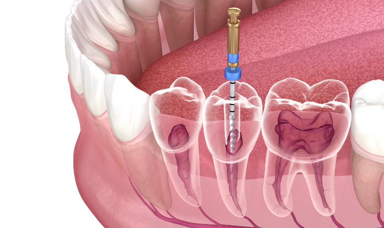 徹底的な感染源の除去|まきの歯科