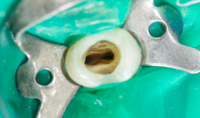 歯質の保存|まきの歯科