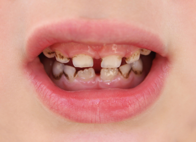 乳歯の虫歯 影響｜まきの歯科