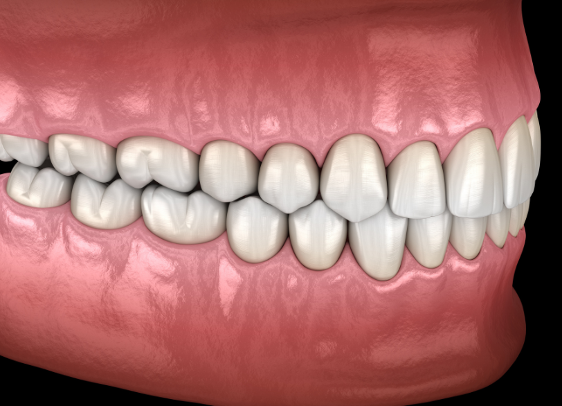 噛み合わせ｜まきの歯科