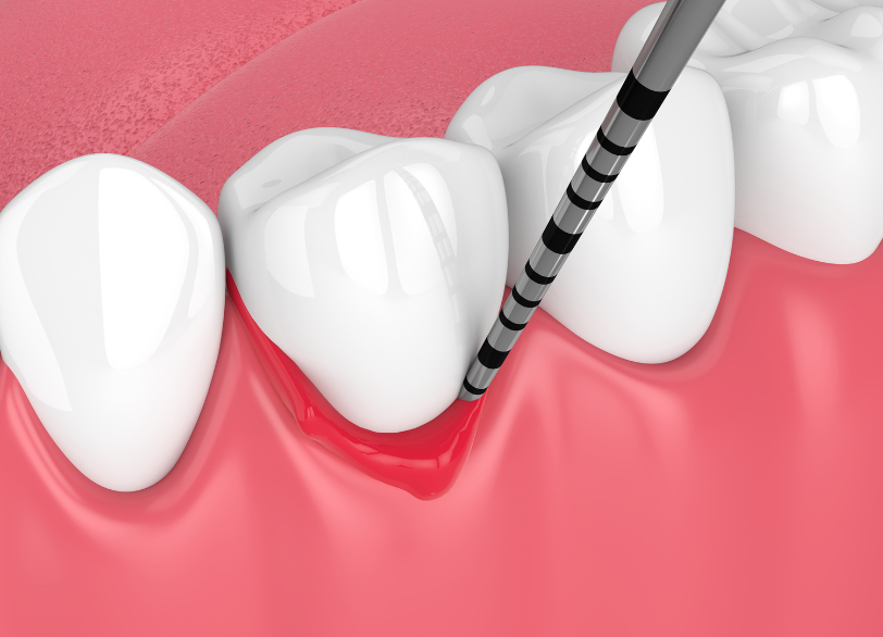 歯周病|まきの歯科
