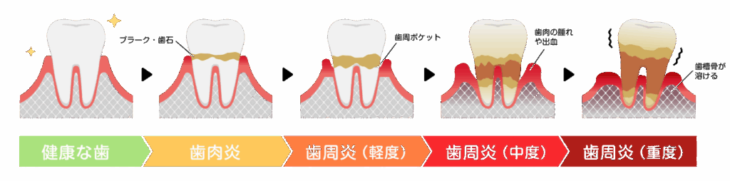 歯周病の進行|まきの歯科