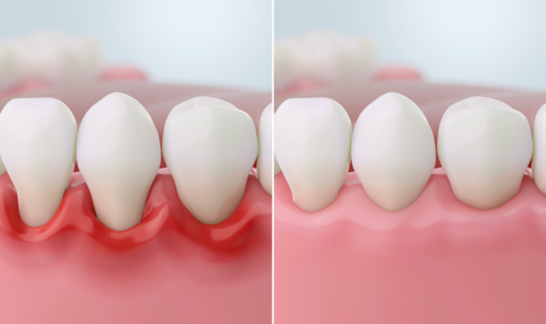 歯周外科治療|まきの歯科