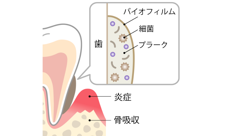 プラーク|まきの歯科