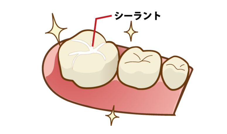 シーラント|まきの歯科